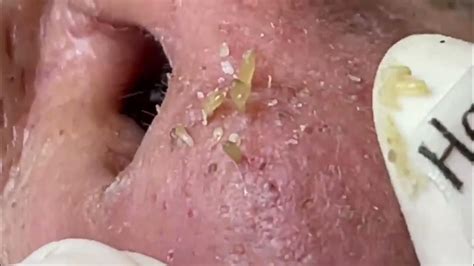 hl; bu. . Youtube blackheads may 2022